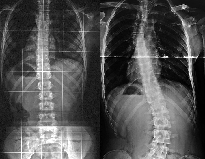 Escoliose na Infância e Adolescência