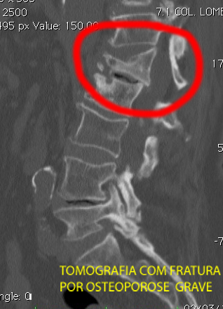 tomografia com fratura por osteoporose grave
